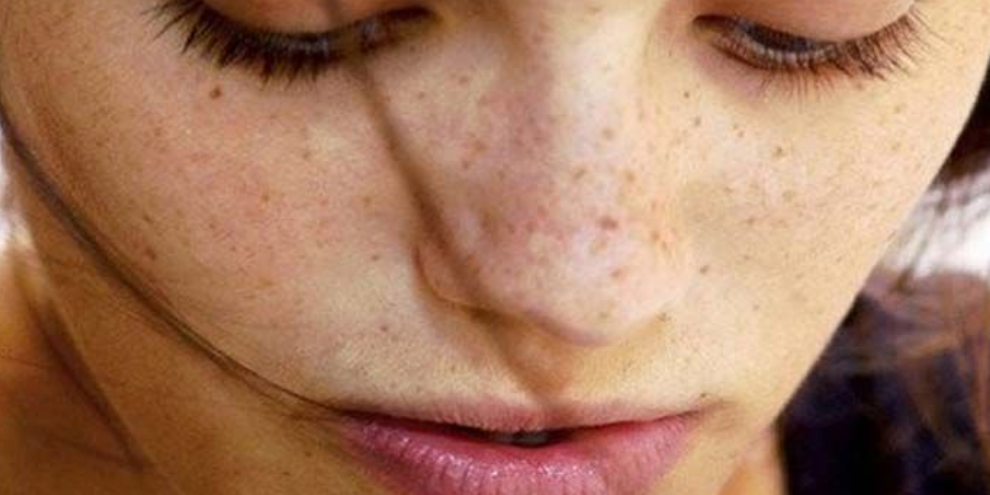 Acne Scars skin concerns