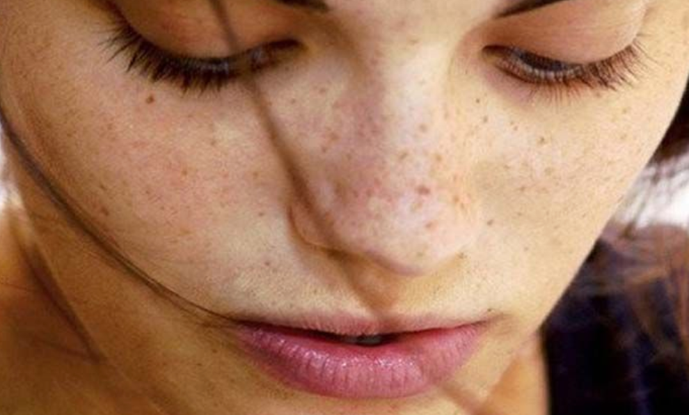 Acne Scars skin concerns