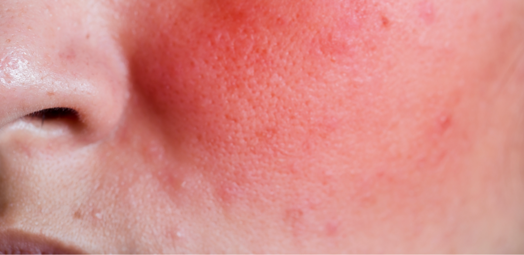 Irritant redness skin concerns