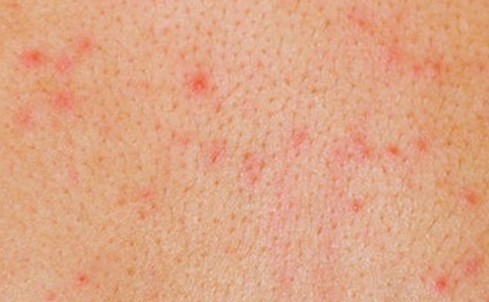 Occasional Pimples skin concerns